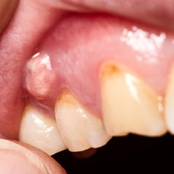 Closeup of abscess causing toothache in Mckinney