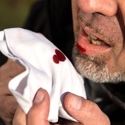 Man with dental emergency in McKinney bleeding lip