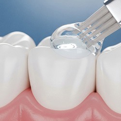 Digital image of a brush painting a sealant onto a back tooth