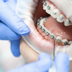 Traditional Braces - Moody & Trussville - Brooks Orthodontics