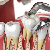 Illustration of a large tooth being removed with forceps