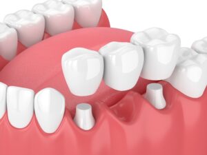 Model of traditional fixed dental bridge