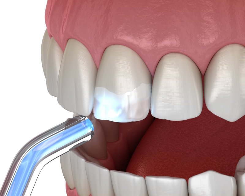 digital image of dental bonding process